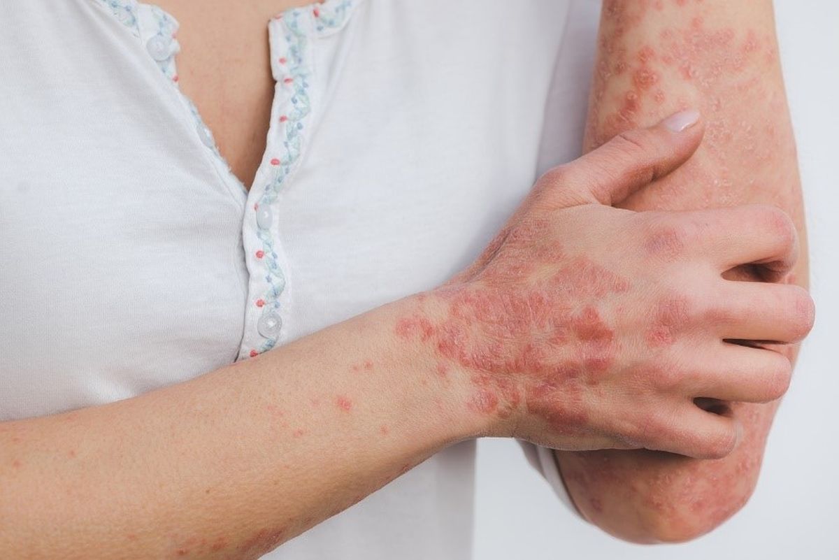 Ako imate psorijazu, ovih 6 namirnica trebalo bi češće da jedete ovo: Mogu da ublaže svrab i crvenilo