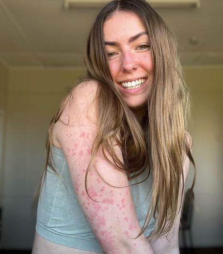 Psoriasis Advocate and Model - Bree Pease