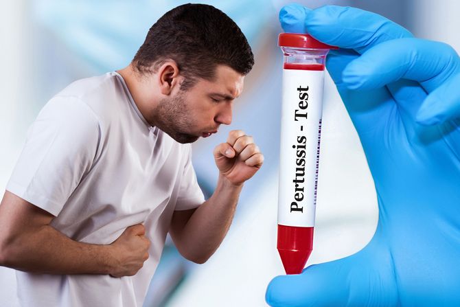 Veliki kašalj, Pertussis Veliki kašalj, Pertussis