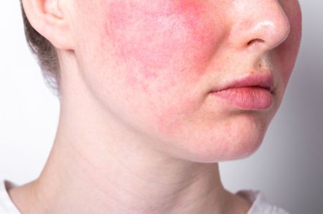 Alergija, koža, lice