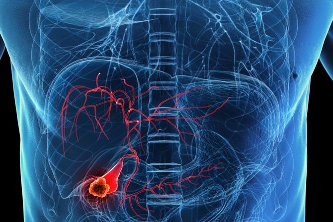 Rak žučnog kanala Rak žučnog kanala