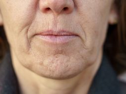 brada, rupice na bradi