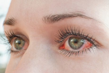 alergija oči crvenilo konjuktivitis infekcija
