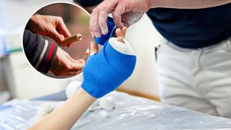 Gips ruka prst povreda previjanje zavoj operacija ruka petarda