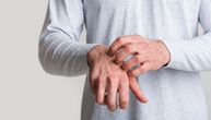 Prirodni spas za upaljenu kožu: Pomešajte ova 3 sastojka i dobićete najbolji domaći melem protiv ekcema