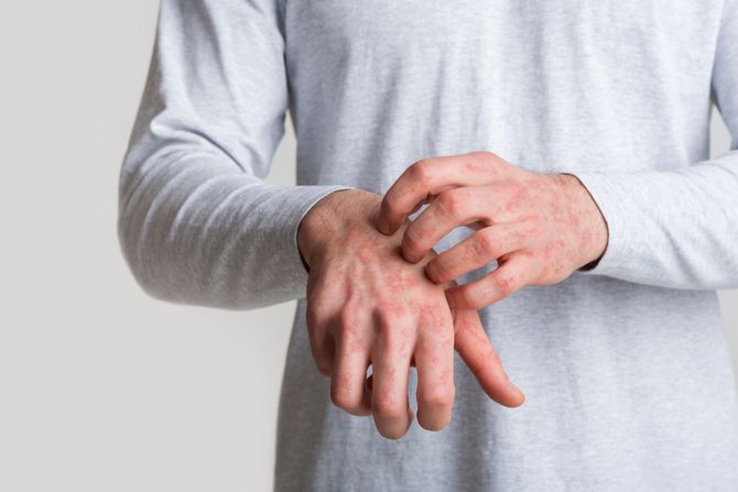 crvenilo na koži, crvene tačkice, osip, koža, ekcem