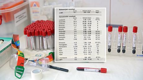 Testiranje na HIV rezultati krvi