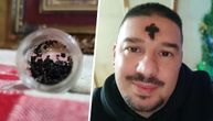 Nenad iz Pančeva sakuplja kraste sa svog čela u staklene posudice: Otkrio je šta radi s njima
