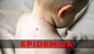 Epidemija malih boginja bukti u Beogradu: Sve je više obolele dece širom Srbije