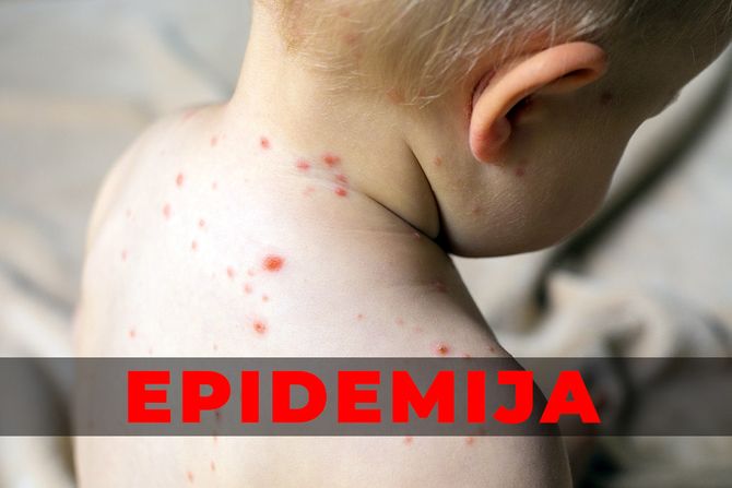 male boginje, morbili Epidemija