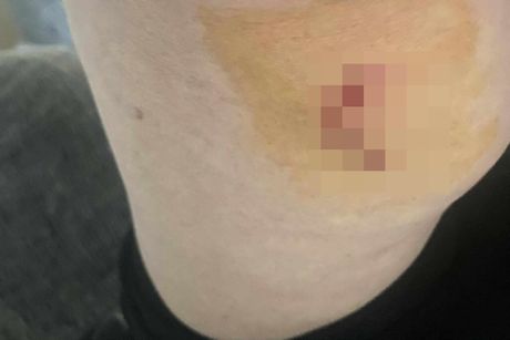 Žene izujedao čopor pasa u Leskovcu