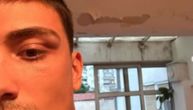 Oglasio se Danilo! Pokazao ogrebotine i modrice na oku: Tvrdi da mu ih je Tara nanela, i da je bila u zatvoru