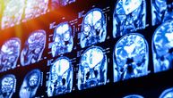 Australijskom lekaru podvrgnutom eksperimentalnoj terapiji se ne vraća tumor mozga