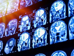 mozak skener rak  mozga