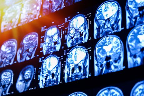 mozak skener rak  mozga
