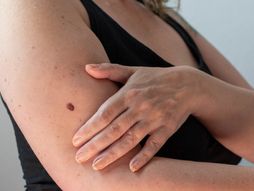 melanom, koža, melanom kože