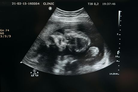 ultrazvuk blizanci