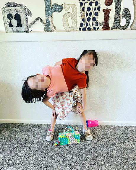 Sijamske bliznakinje