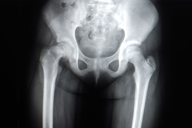 rendgen međunozje rendgen međunozje