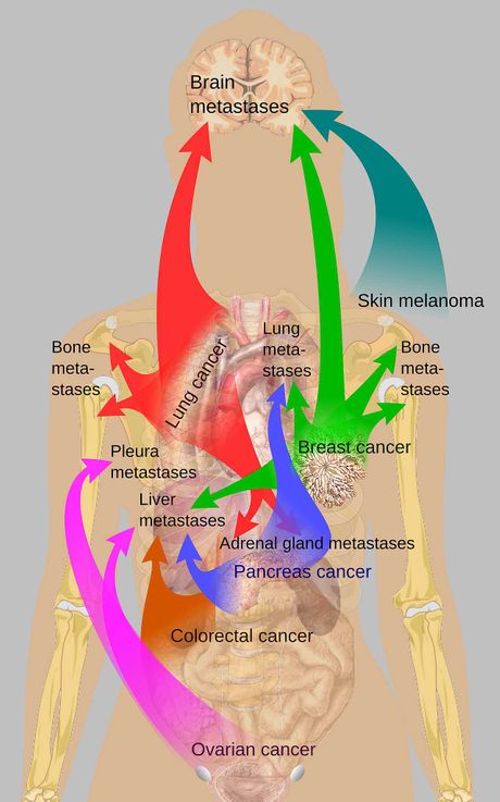 rak, kancer, metastaze