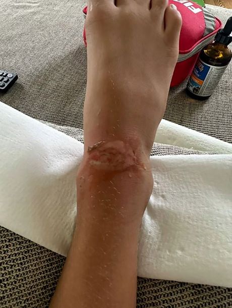 Devojčica opekotine