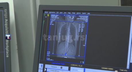 skrining za rano otkrivanje raka pluća