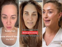 Botoks greške