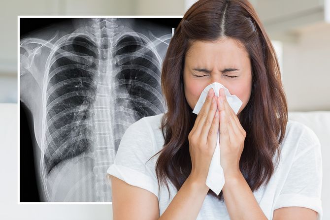 Prehlada rendgen Prehlada rendgen