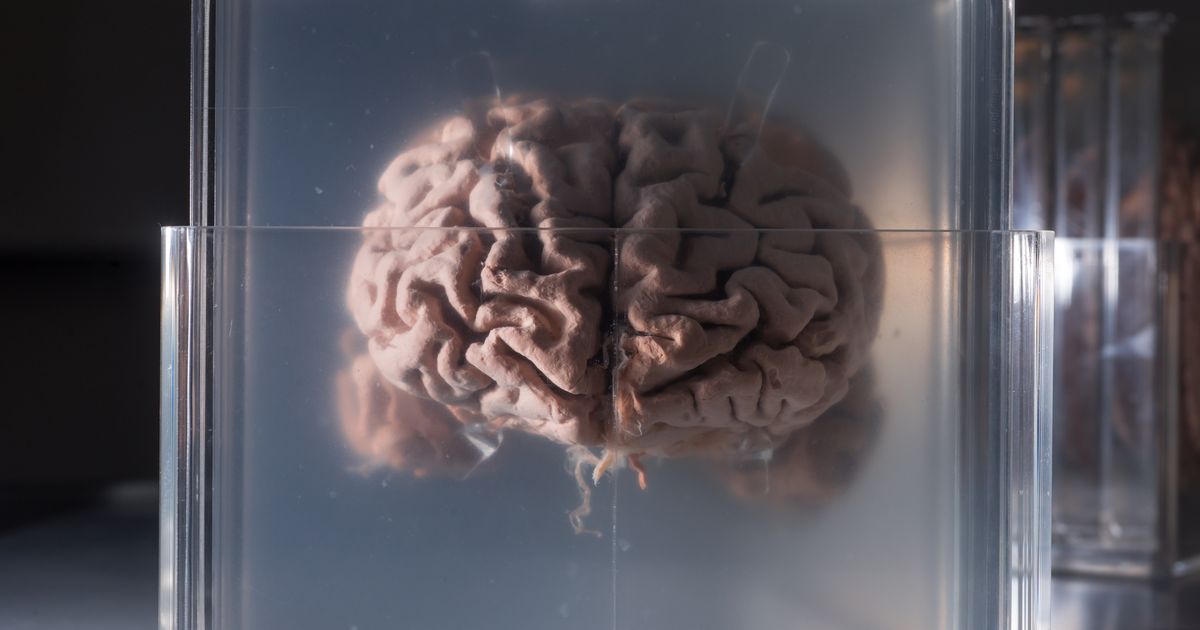 Scientists Discover What Happens to the Brain After Death: 'It's a Gradual Process, It Can Last for Hours'
