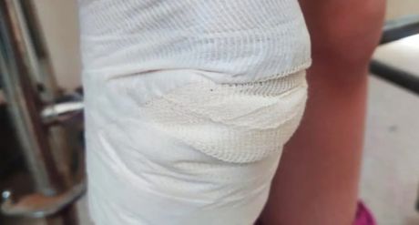 Novi Pazar, napad pasa, devojčica, izujedano dete