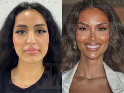 Pikaso tehnika plastična hirurgija