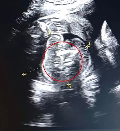 fetus fetus