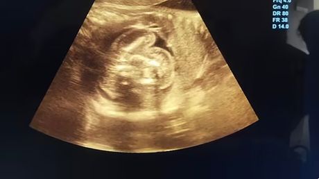 fetus fetus