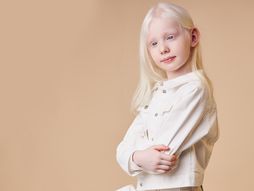 albino, albino devojčica, albinizam