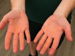 čiz hends, nakupljanje holesterola