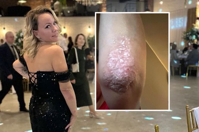 Psorijaza Psorijaza
