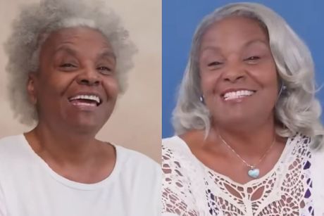 Plastična operacija pre i posle