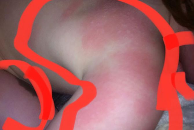 alergicna na sunce alergicna na sunce