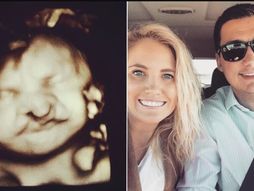 Deformitet, beba, Sara