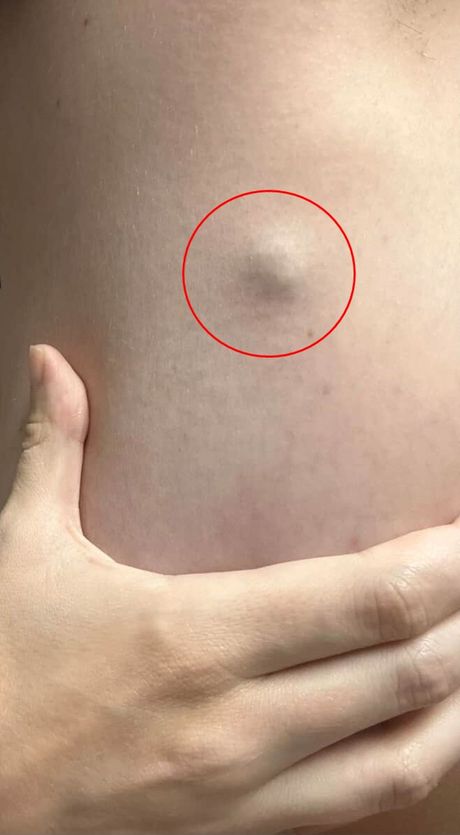 Kajli rak kože Kajli rak kože