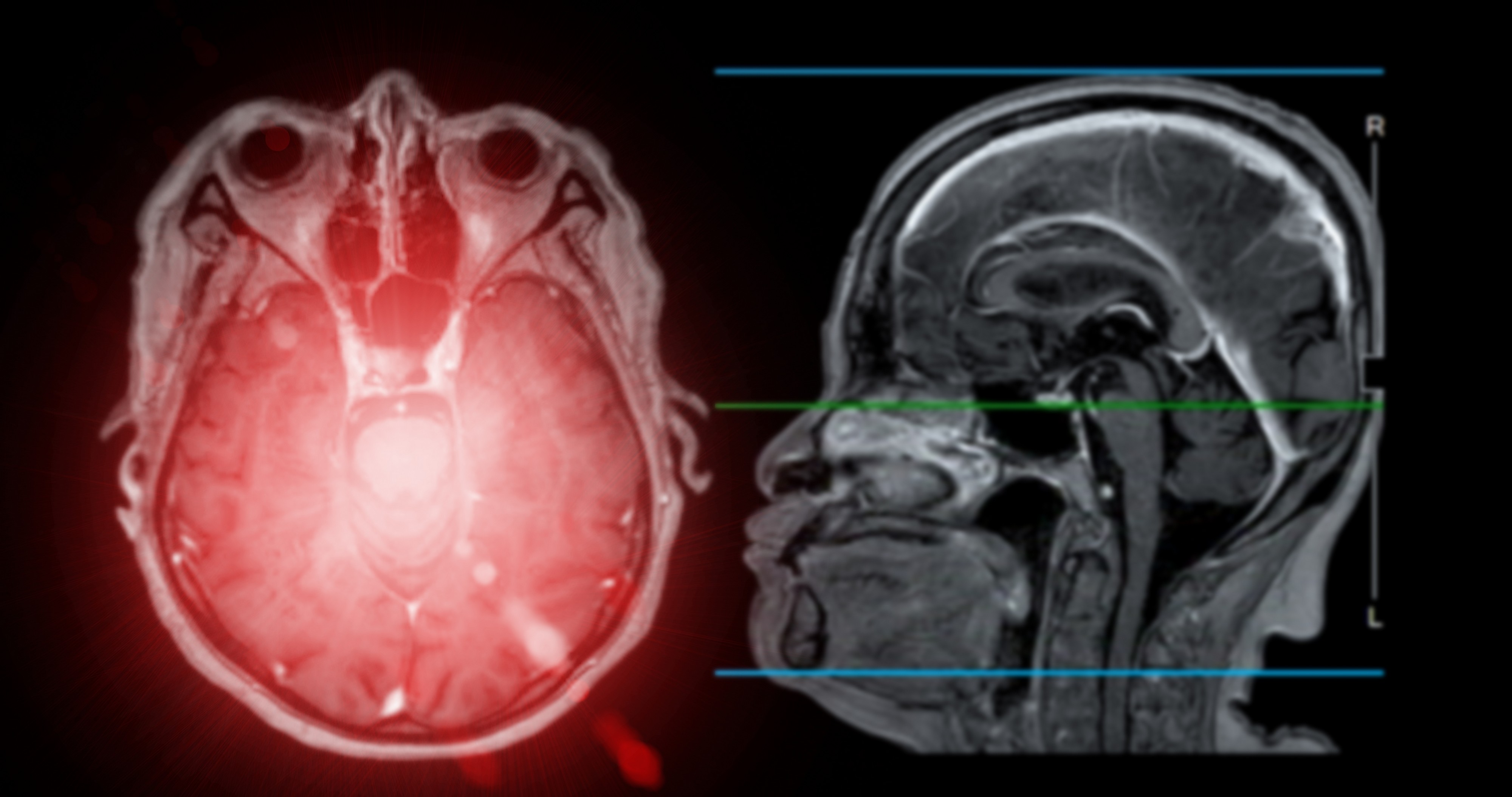 Razvijen novi preparat za dijagnostiku i lečenje glioma