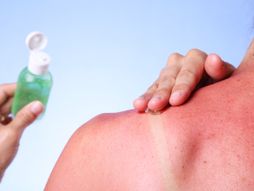 aloe vera, aloe vera gel, opekotina, opekotina od sunca, izgorela koža, nega kože, sunčanje