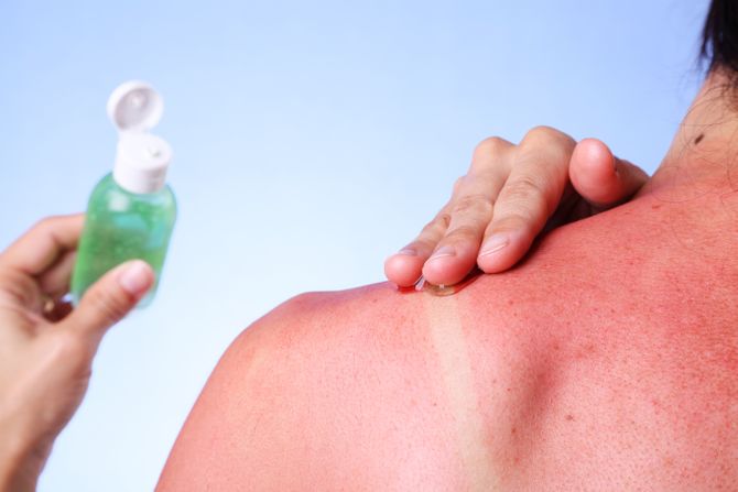 aloe vera, aloe vera gel, opekotina, opekotina od sunca, izgorela koža, nega kože, sunčanje aloe vera, aloe vera gel, opekotina, opekotina od sunca, izgorela koža, nega kože, sunčanje