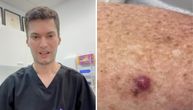 Lekar objavio video uz upozorenje: Ako vidite OVO na koži - odmah idite lekaru! Ne može gore od toga!
