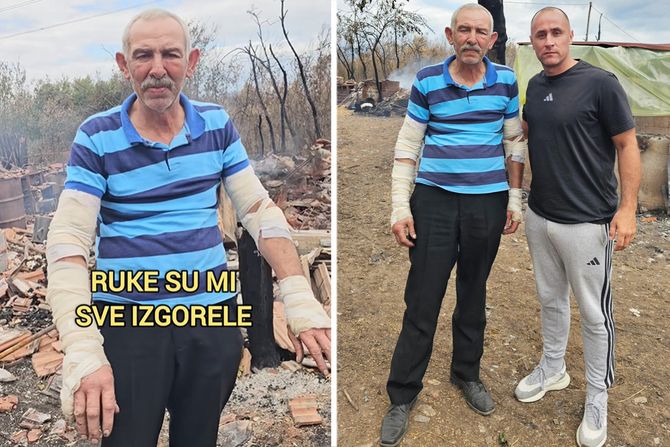 Izgorele mu ruke dok je gasio požar Izgorele mu ruke dok je gasio požar