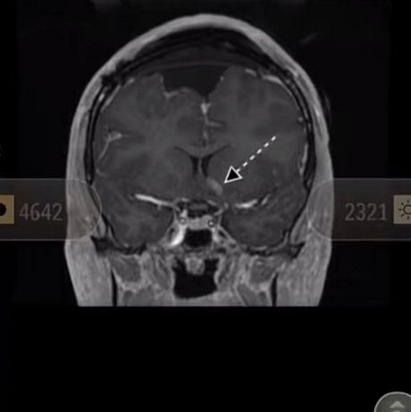 Žena tumor na mozgu Žena tumor na mozgu