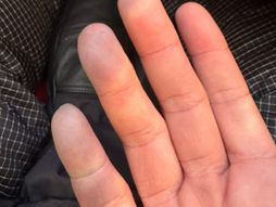 Promrzline na prstima