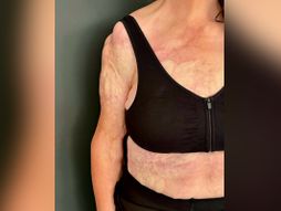 Ožiljci od skidanja tetovaže