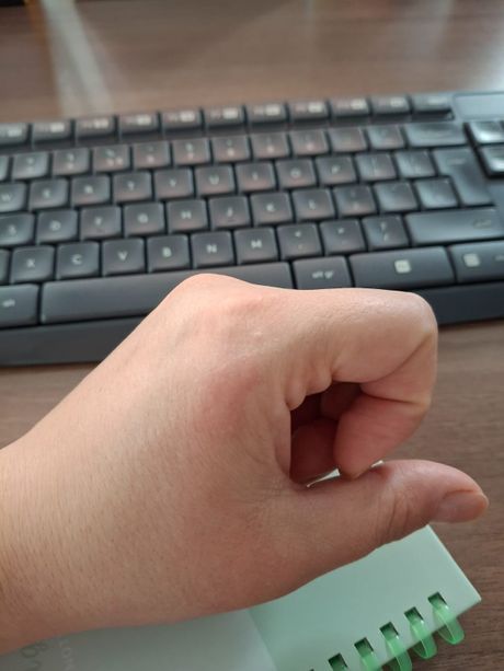 Alergija na gel lak za nokte Alergija na gel lak za nokte