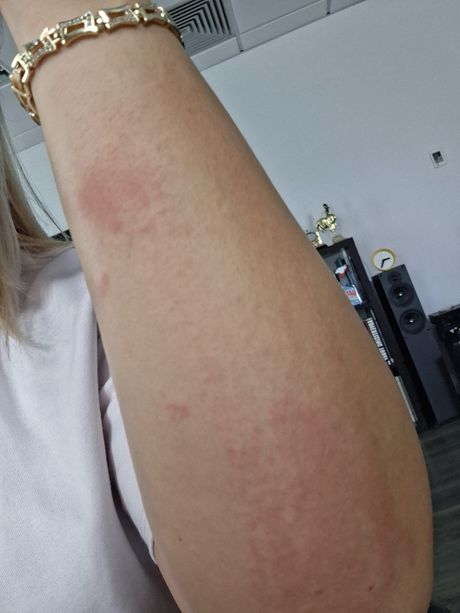 Alergija na gel lak za nokte Alergija na gel lak za nokte